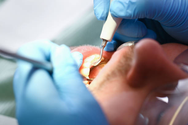Best Emergency Treatment for Dental Infections or Abscesses in Wedgefield, FL