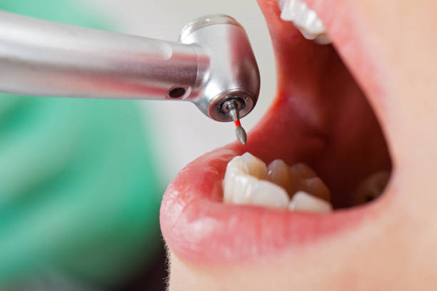 Best Emergency Root Canal Treatment in Wedgefield, FL